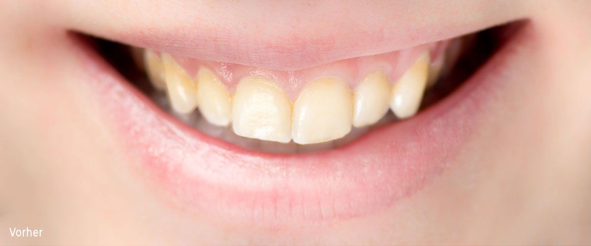 Zahnarzt Kaya Rodgau - Vor der Zahnaufhellung